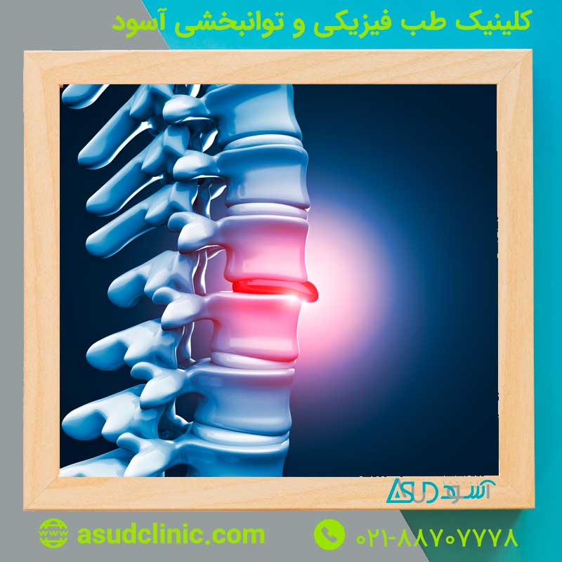 فتق دیسک گردن